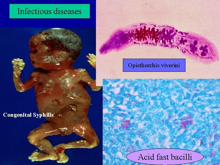 Infectious diseases Opisthorchis viverini Congenital Syphilis Acid fast bacilli 