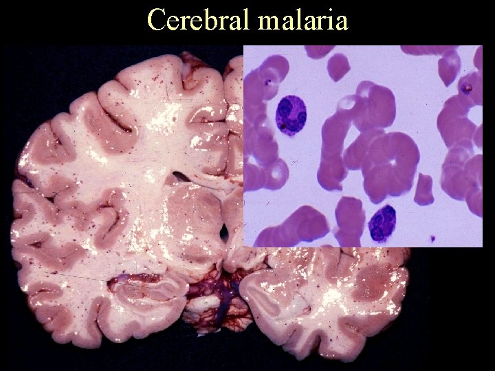 Cerebral malaria 