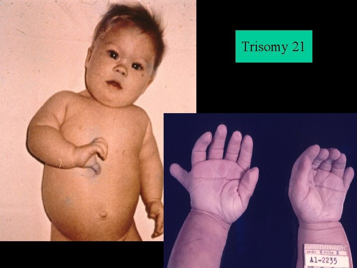 Trisomy 21 Mongolism (Down syndrome) 