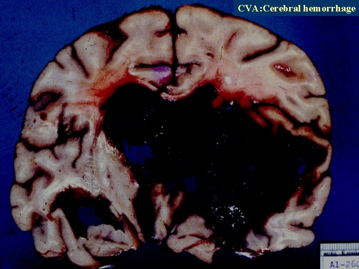 CVA: Cerebral hemorrhage 