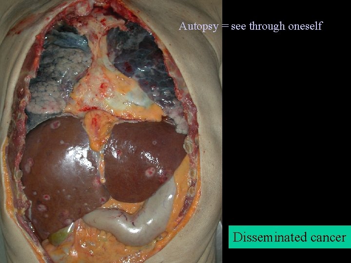 Autopsy = see through oneself Disseminated cancer 