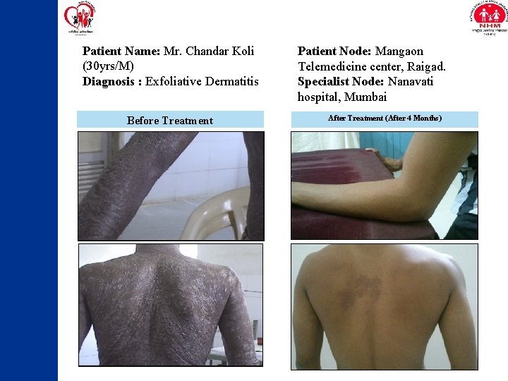 Patient Name: Mr. Chandar Koli (30 yrs/M) Diagnosis : Exfoliative Dermatitis Before Treatment Patient