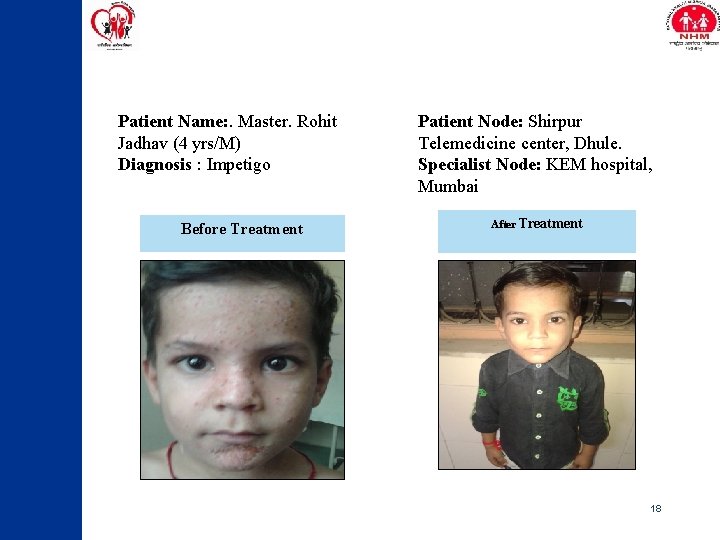 Patient Name: . Master. Rohit Jadhav (4 yrs/M) Diagnosis : Impetigo Before Treatment Patient