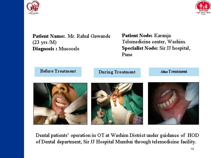 Patient Name: . Mr. Rahul Gawande (23 yrs /M) Diagnosis : Mucocele Before Treatment