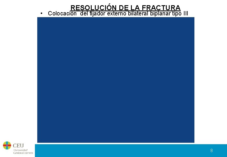 RESOLUCIÓN DE LA FRACTURA • Colocación del fijador externo bilateral biplanar tipo III 8