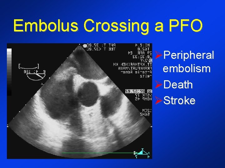 Embolus Crossing a PFO ØPeripheral embolism ØDeath ØStroke 