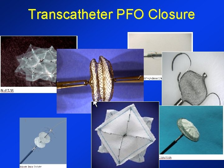 Transcatheter PFO Closure 