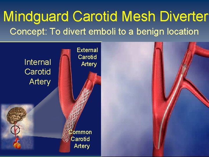 Mindguard Carotid Mesh Diverter Concept: To divert emboli to a benign location Internal Carotid