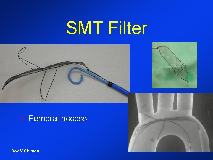 SMT Filter • Femoral access Dov V Shimon 