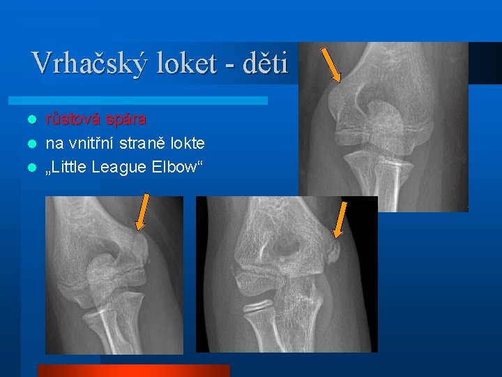 Vrhačský loket - děti růstová spára l na vnitřní straně lokte l „Little League