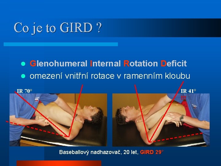 Co je to GIRD ? Glenohumeral Internal Rotation Deficit l omezení vnitřní rotace v