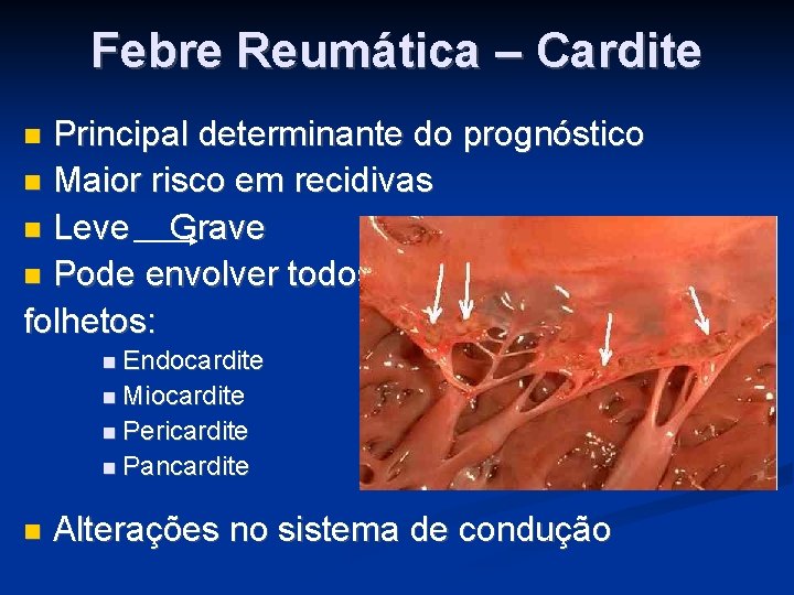 Febre Reumática – Cardite Principal determinante do prognóstico Maior risco em recidivas Leve Grave