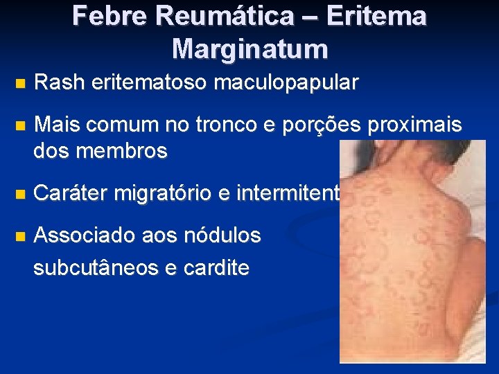 Febre Reumática – Eritema Marginatum Rash eritematoso maculopapular Mais comum no tronco e porções