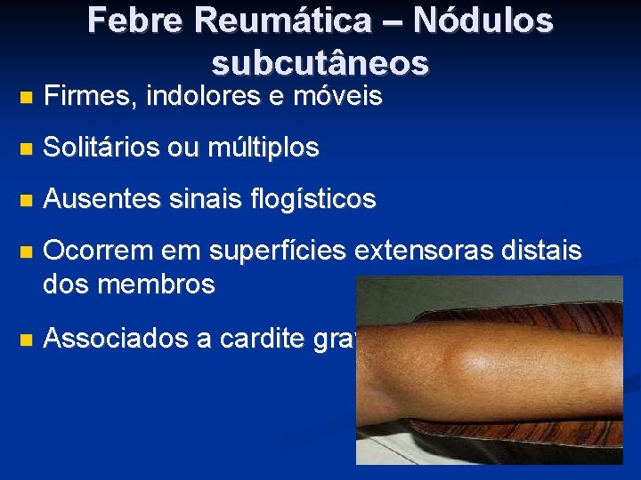 Febre Reumática – Nódulos subcutâneos Firmes, indolores e móveis Solitários ou múltiplos Ausentes sinais