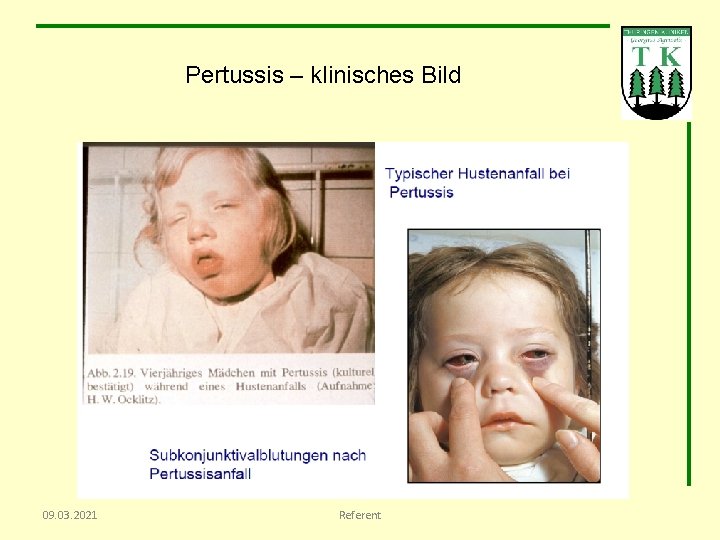 Pertussis – klinisches Bild 09. 03. 2021 Referent 