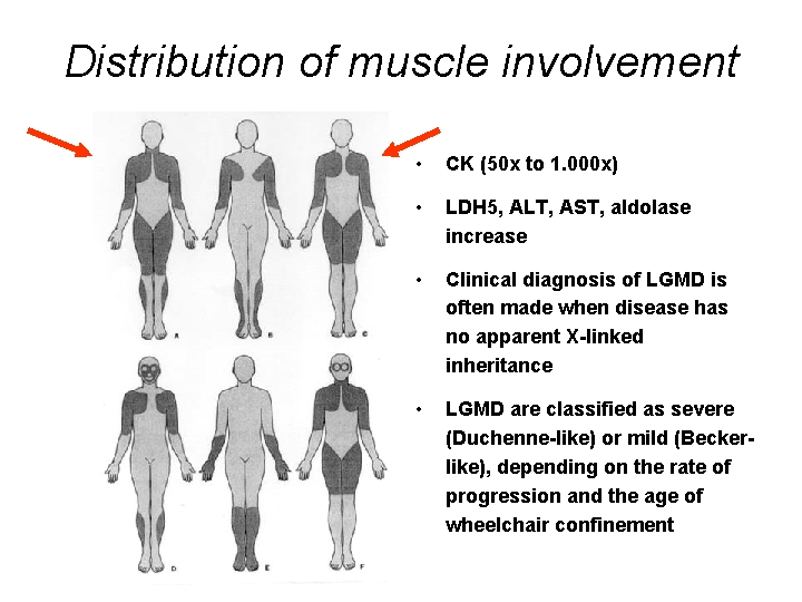 Distribution of muscle involvement • CK (50 x to 1. 000 x) • LDH