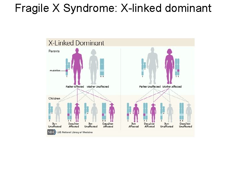Fragile X Syndrome: X-linked dominant 