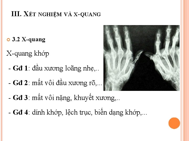 III. XÉT NGHIỆM VÀ X-QUANG 3. 2 X-quang khớp - Gđ 1: đầu xương