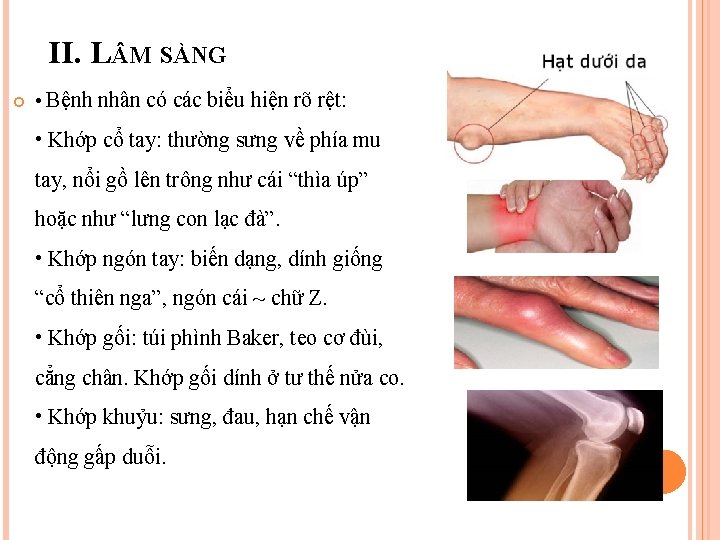 II. L M SÀNG • Bệnh nhân có các biểu hiện rõ rệt: •