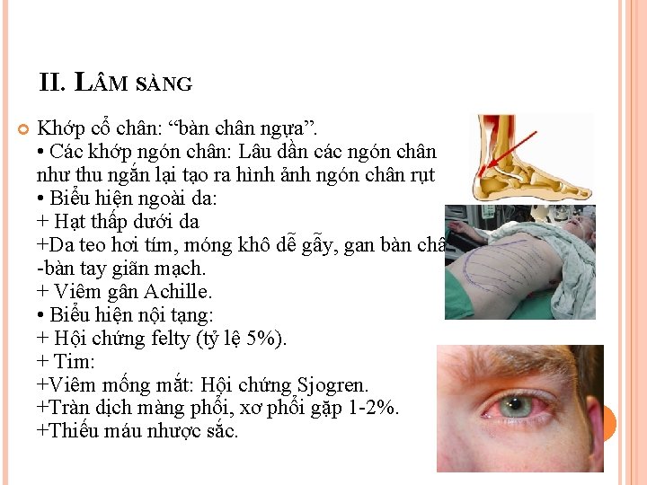 II. L M SÀNG Khớp cổ chân: “bàn chân ngựa”. • Các khớp ngón