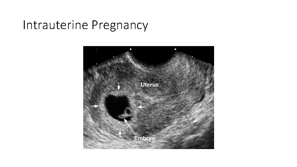 Intrauterine Pregnancy 