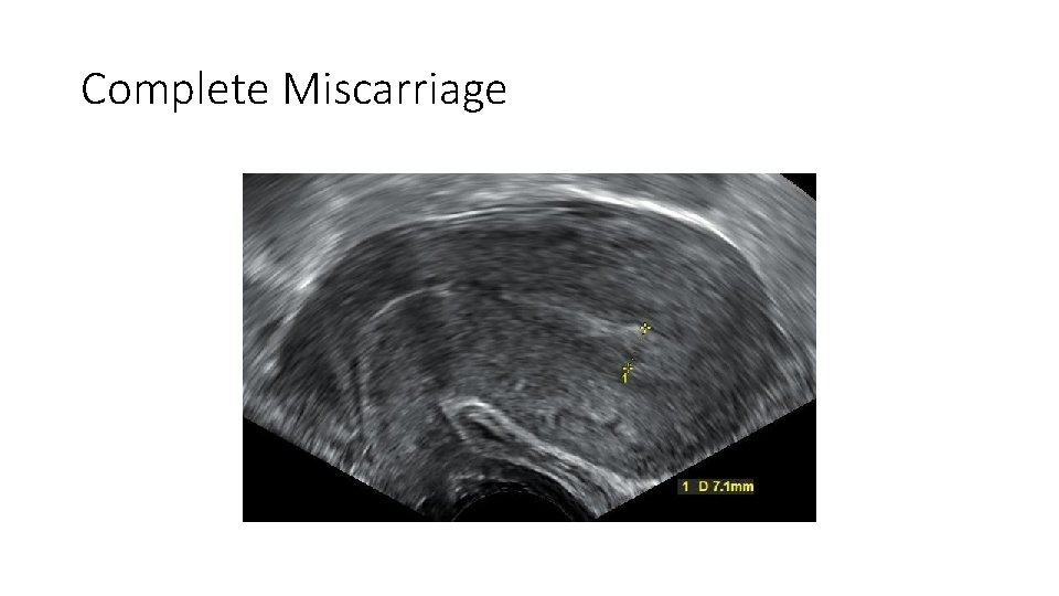 Complete Miscarriage 