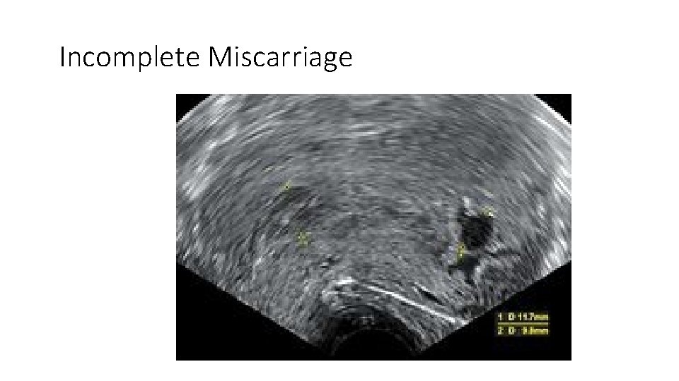 Incomplete Miscarriage 