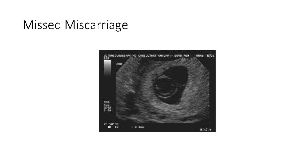 Missed Miscarriage 