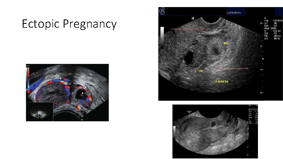 Ectopic Pregnancy 