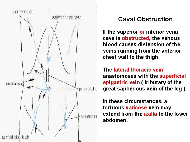 Caval Obstruction If the superior or inferior vena cava is obstructed, the venous blood