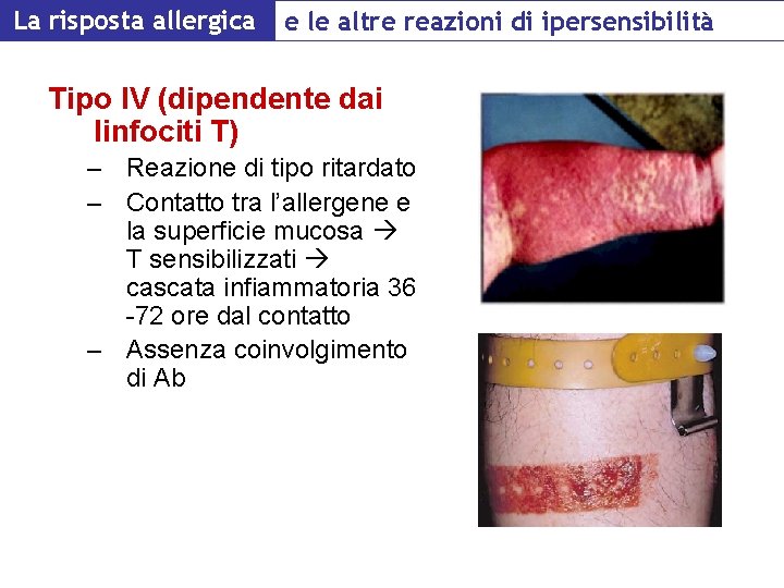 La risposta allergica e le altre reazioni di ipersensibilità Tipo IV (dipendente dai linfociti