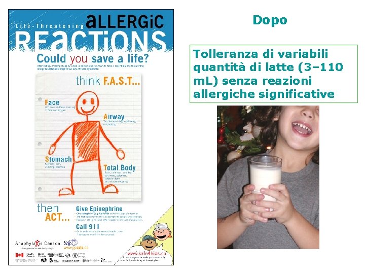 Prima Reazioni allergiche gravi anche per quantità minime di latte assunto Dopo Tolleranza di