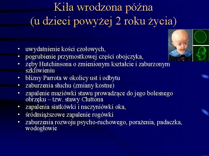 Kiła wrodzona późna (u dzieci powyżej 2 roku życia) • uwydatnienie kości czołowych, •