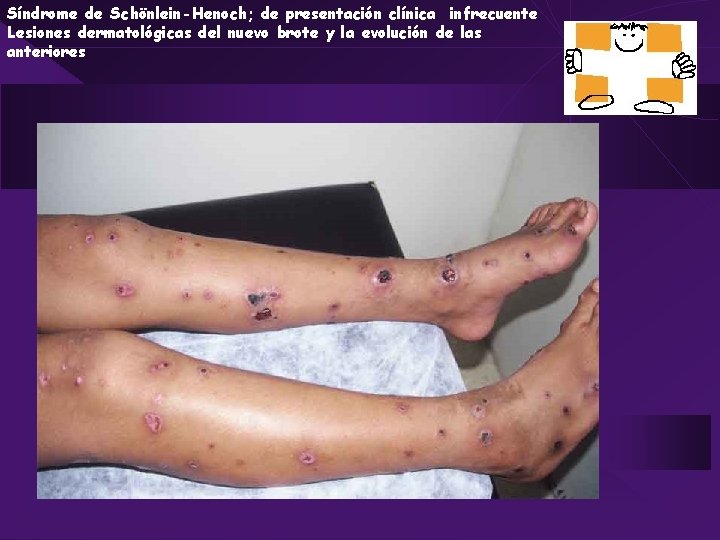 Síndrome de Schönlein-Henoch; de presentación clínica infrecuente Lesiones dermatológicas del nuevo brote y la