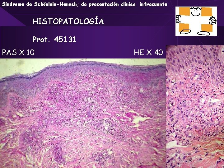 Síndrome de Schönlein-Henoch; de presentación clínica infrecuente HISTOPATOLOGÍA Prot. 45131 PAS X 10 HE