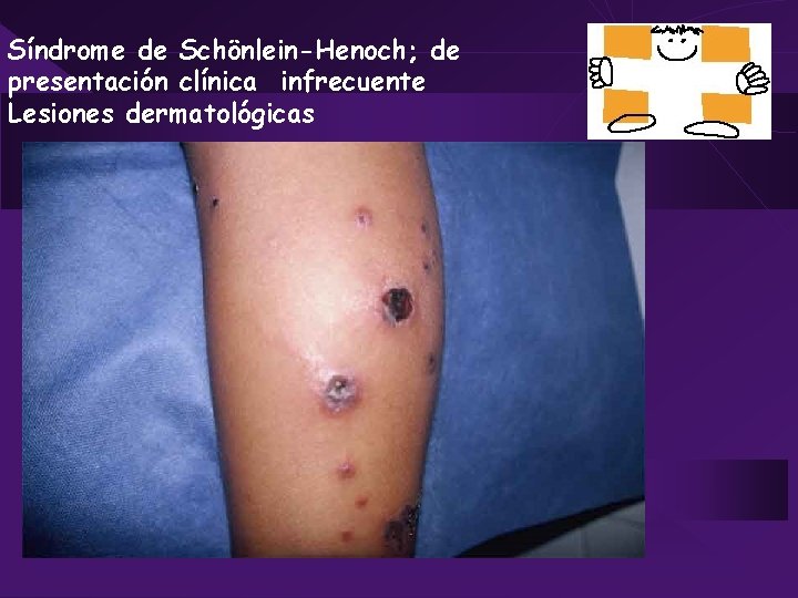 Síndrome de Schönlein-Henoch; de presentación clínica infrecuente Lesiones dermatológicas 