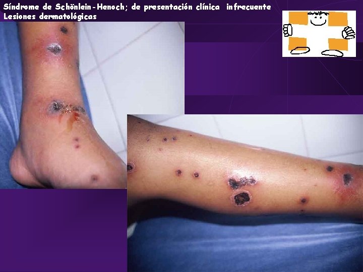 Síndrome de Schönlein-Henoch; de presentación clínica infrecuente Lesiones dermatológicas 