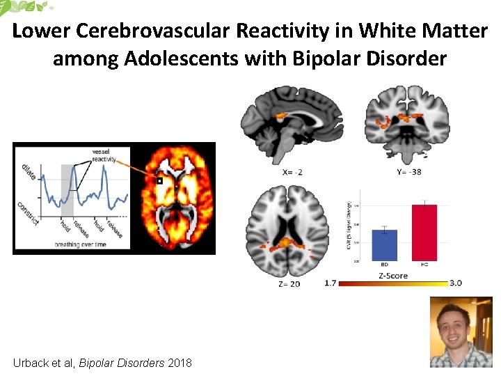 Lower Cerebrovascular Reactivity in White Matter among Adolescents with Bipolar Disorder Urback et al,