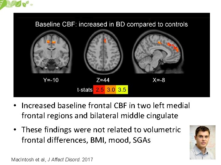  • Increased baseline frontal CBF in two left medial frontal regions and bilateral