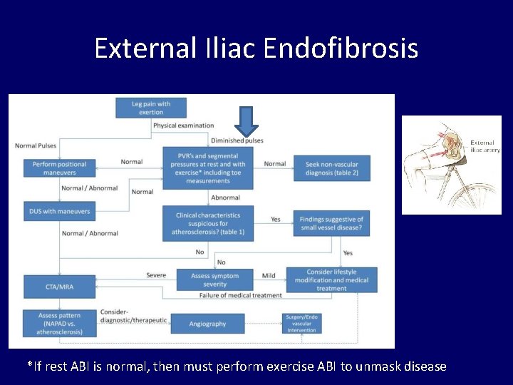 External Iliac Endofibrosis *If rest ABI is normal, then must perform exercise ABI to