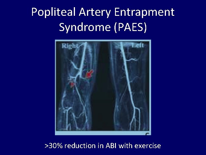 Popliteal Artery Entrapment Syndrome (PAES) >30% reduction in ABI with exercise 