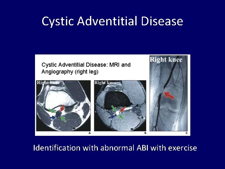 Cystic Adventitial Disease: MRI and Angiography (right leg) Identification with abnormal ABI with exercise