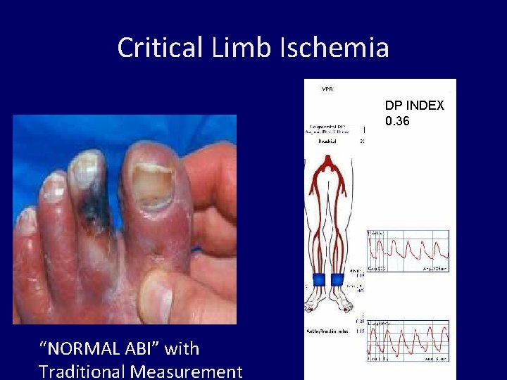 Critical Limb Ischemia DP INDEX 0. 36 “NORMAL ABI” with Traditional Measurement 