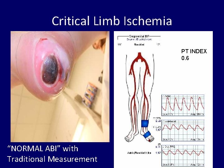 Critical Limb Ischemia PT INDEX 0. 6 “NORMAL ABI” with Traditional Measurement 