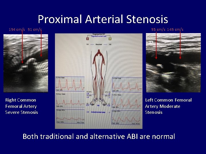 Proximal Arterial Stenosis 194 cm/s 91 cm/s Right Common Femoral Artery Severe Stenosis 95