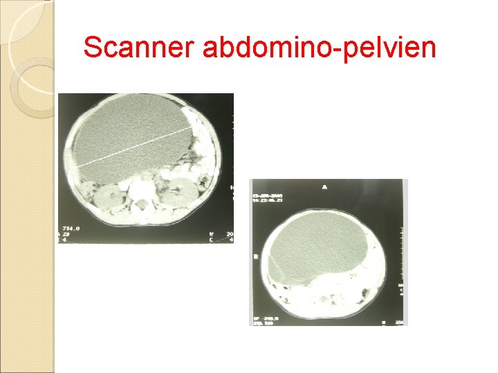 Scanner abdomino-pelvien 