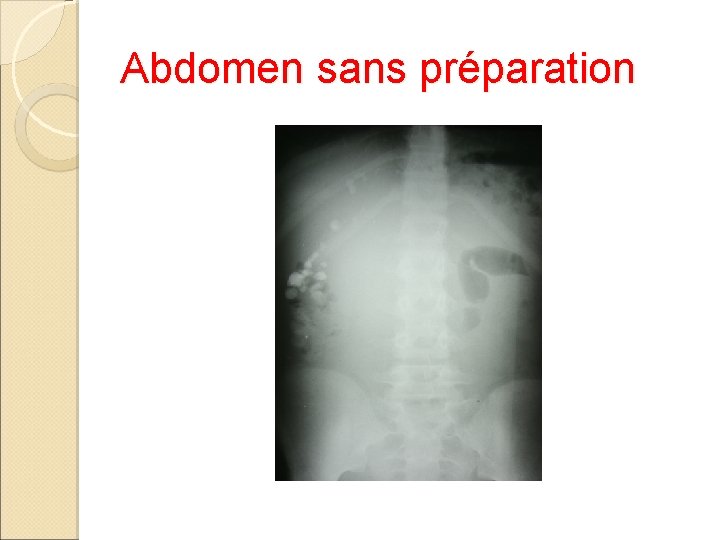 Abdomen sans préparation 