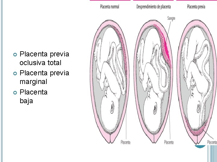 Placenta previa oclusiva total Placenta previa marginal Placenta baja 