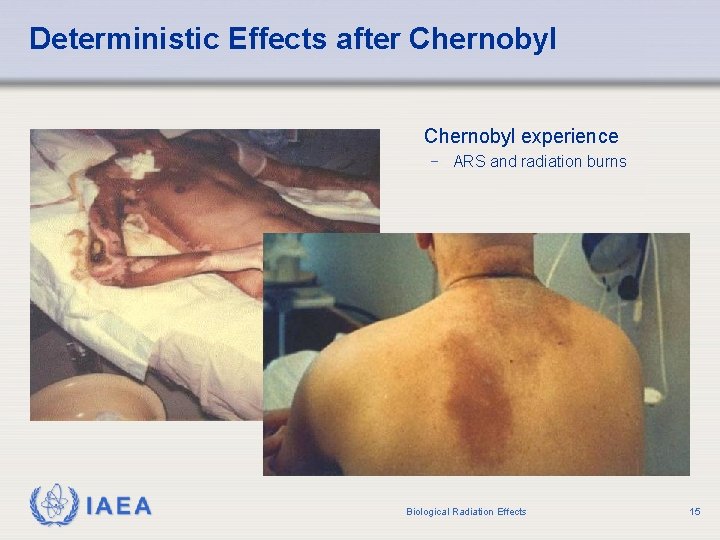 Deterministic Effects after Chernobyl experience − ARS and radiation burns IAEA Biological Radiation Effects