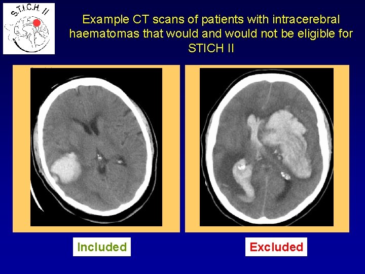 Example CT scans of patients with intracerebral haematomas that would and would not be
